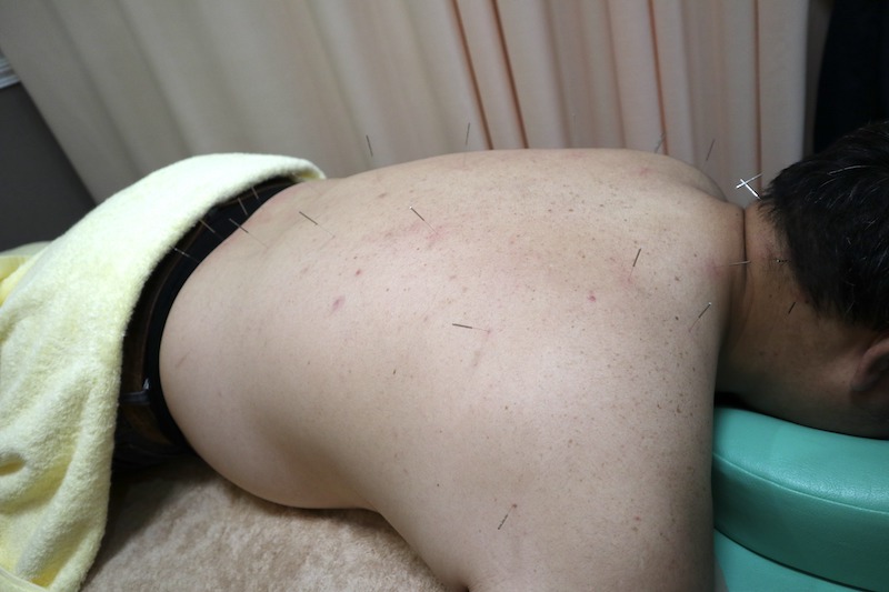 腰のヘルニアに効果的な鍼療法!